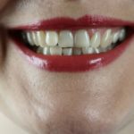 Zubní implantáty Praha jsou skvělé, vlastní zuby jsou však lepší